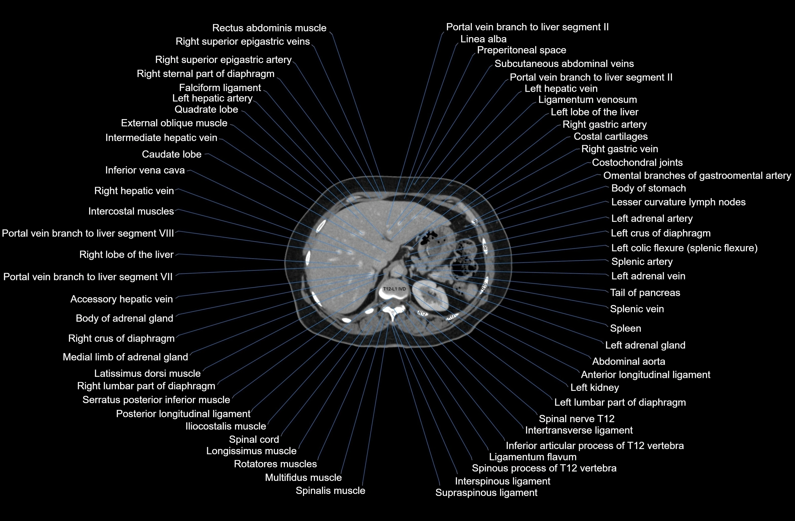 CT Abdomen axial cross sectional anatomy labelled radiology image-00021.webp
